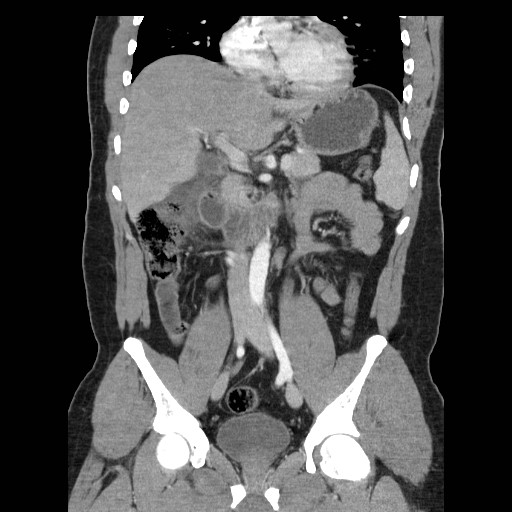 Subhepatic Appendicitis With Appendicolith Image