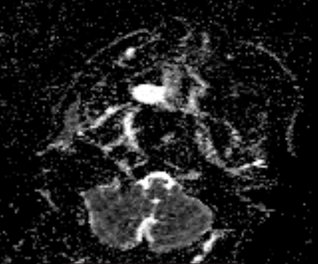 Wallenberg syndrome ( lateral medullary syndrome) | Image | Radiopaedia.org