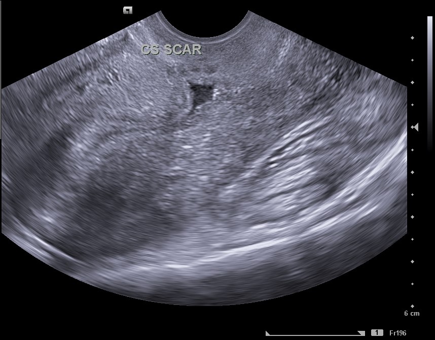 Fluid Filled Cesarean Scar Niche Image