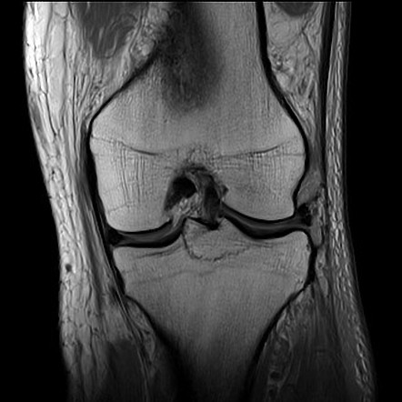 Tibial intercondylar eminence fracture  Radiology Case 