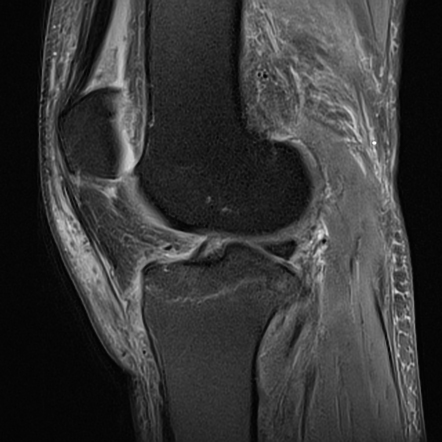 Tibial intercondylar eminence fracture | Image | Radiopaedia.org