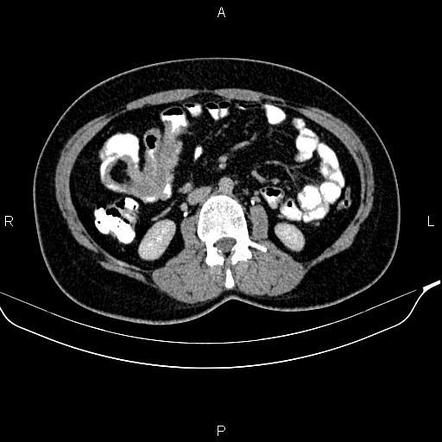 Intussusception | Radiology Reference Article | Radiopaedia.org