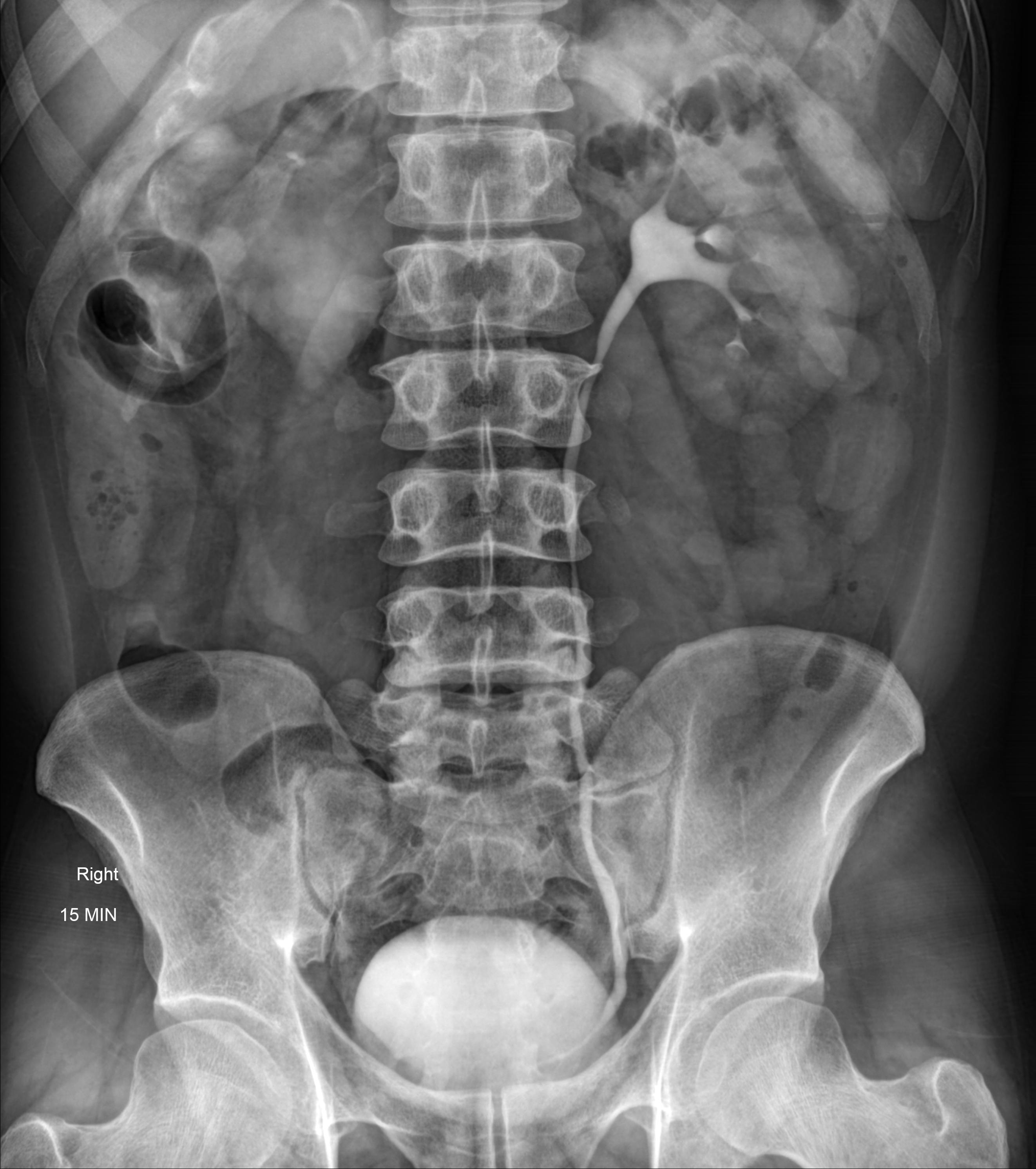 Right Ureteropelvic Junction Obstruction | Image | Radiopaedia.org