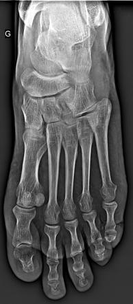 Phalangeal tuft fracture | Image | Radiopaedia.org