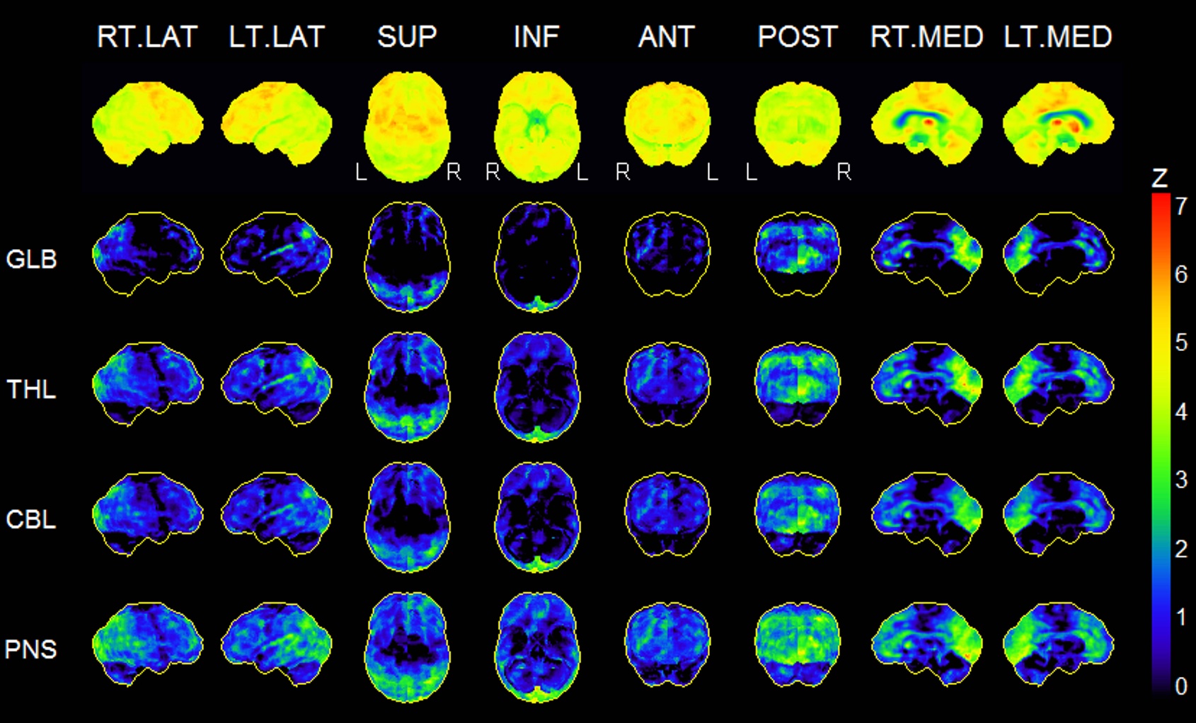 Dementia With Lewy Bodies Image 0860