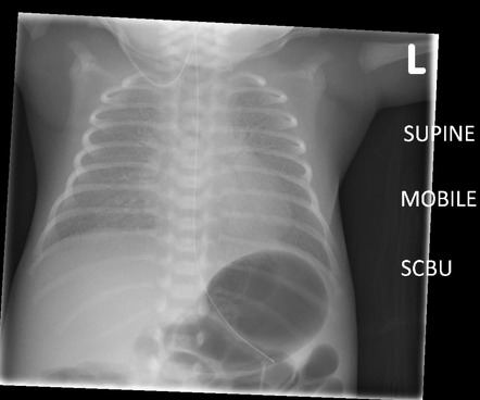 Respiratory Distress Syndrome Radiology Reference Article Radiopaedia Org