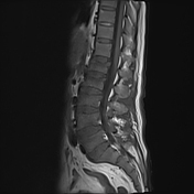 Bone marrow reconversion | Radiology Reference Article | Radiopaedia.org