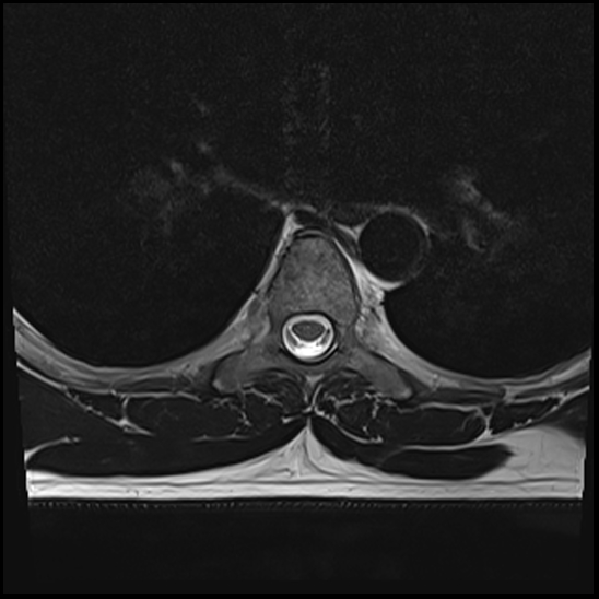 Romanus Lesions Ankylosing Spondylitis Image Radiopaedia Org