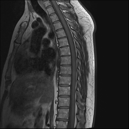 Romanus Lesions Ankylosing Spondylitis Image Radiopaedia Org