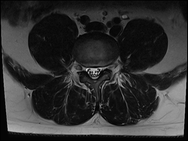 Romanus Lesions Ankylosing Spondylitis Image