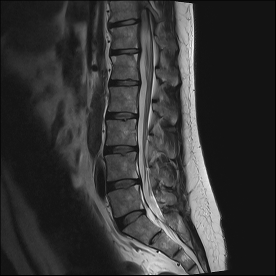 Romanus lesions - ankylosing spondylitis | Image | Radiopaedia.org