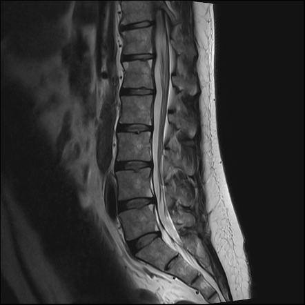 Romanus Lesions Ankylosing Spondylitis Image Radiopaedia Org