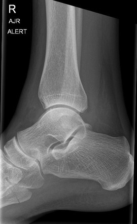 Distal fibular and fifth metatarsal base fractures | Image ...