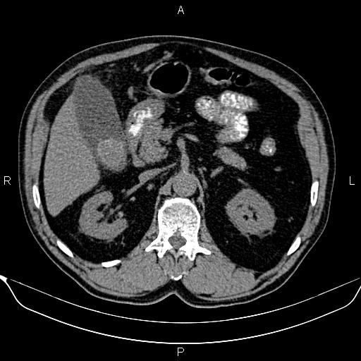 Acute Cholecystitis | Image | Radiopaedia.org