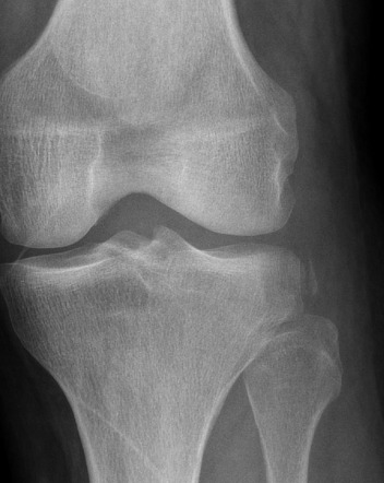 Segond fracture | Radiology Case | Radiopaedia.org