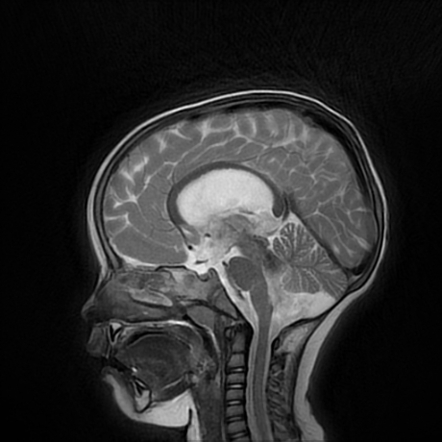 Blake pouch cyst | Radiology Case | Radiopaedia.org