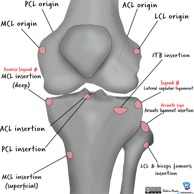 Iliotibial band anatomy showing insertion of in-series muscles