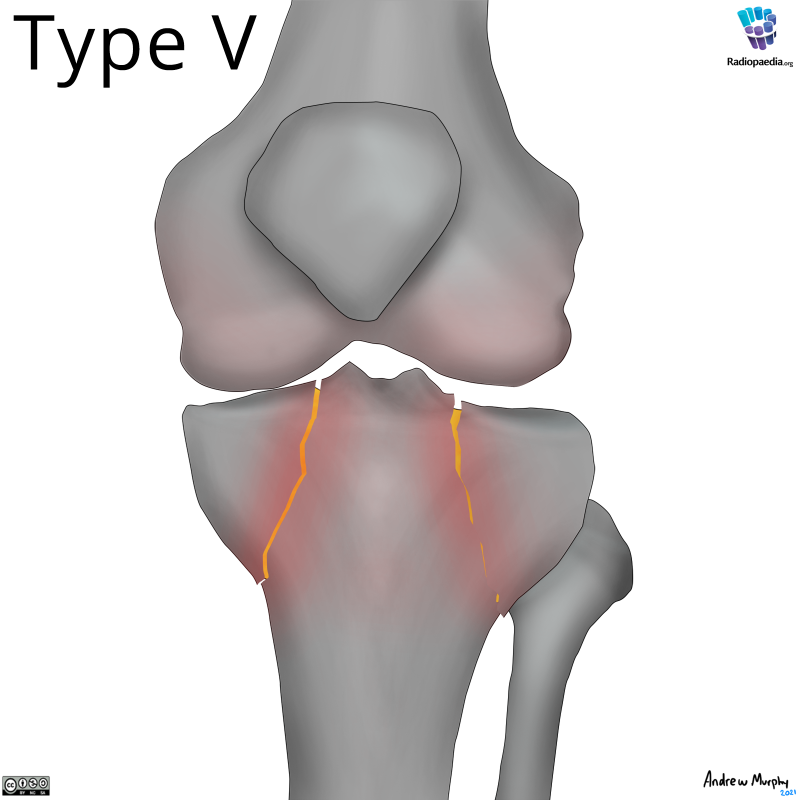 Schatzker classification of tibial plateau fractures (illustrations ...