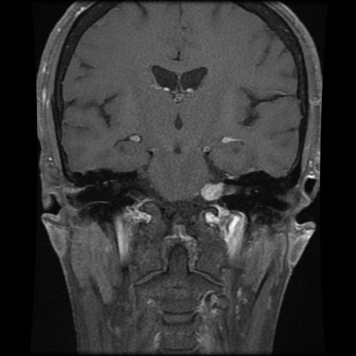 Acoustic neuroma | Image | Radiopaedia.org