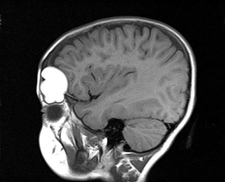 Intradiploic white epidermoid cyst | Radiology Case | Radiopaedia.org