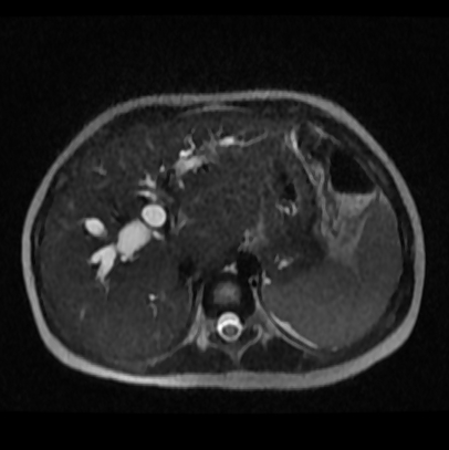 Choledochal cyst - type 4a | Image | Radiopaedia.org