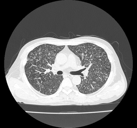 Random pulmonary nodules | Radiology Reference Article | Radiopaedia.org