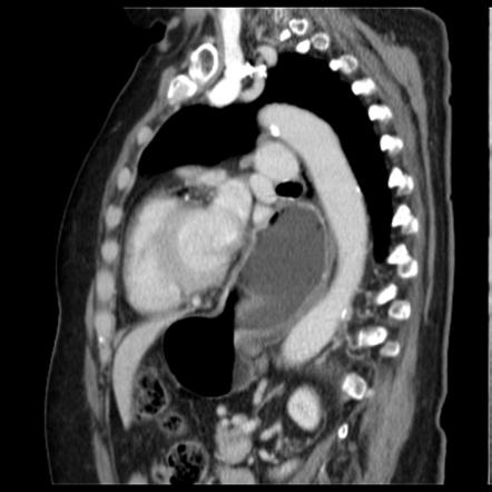 Abdominal hernia | Radiology Reference Article | Radiopaedia.org