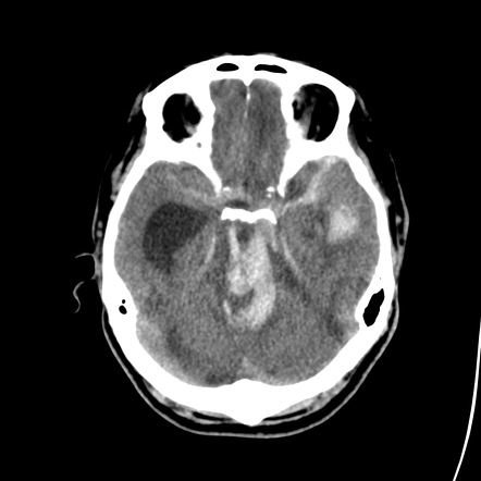 Duret hemorrhages | Radiology Reference Article | Radiopaedia.org