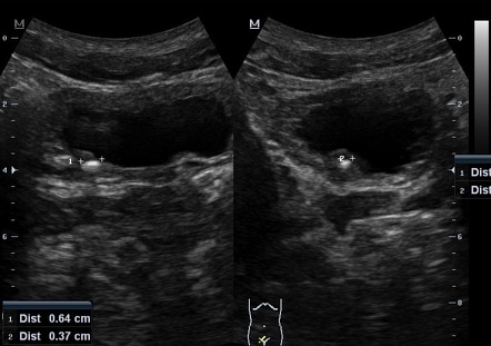 Ureterovesical junction calculus | Image | Radiopaedia.org