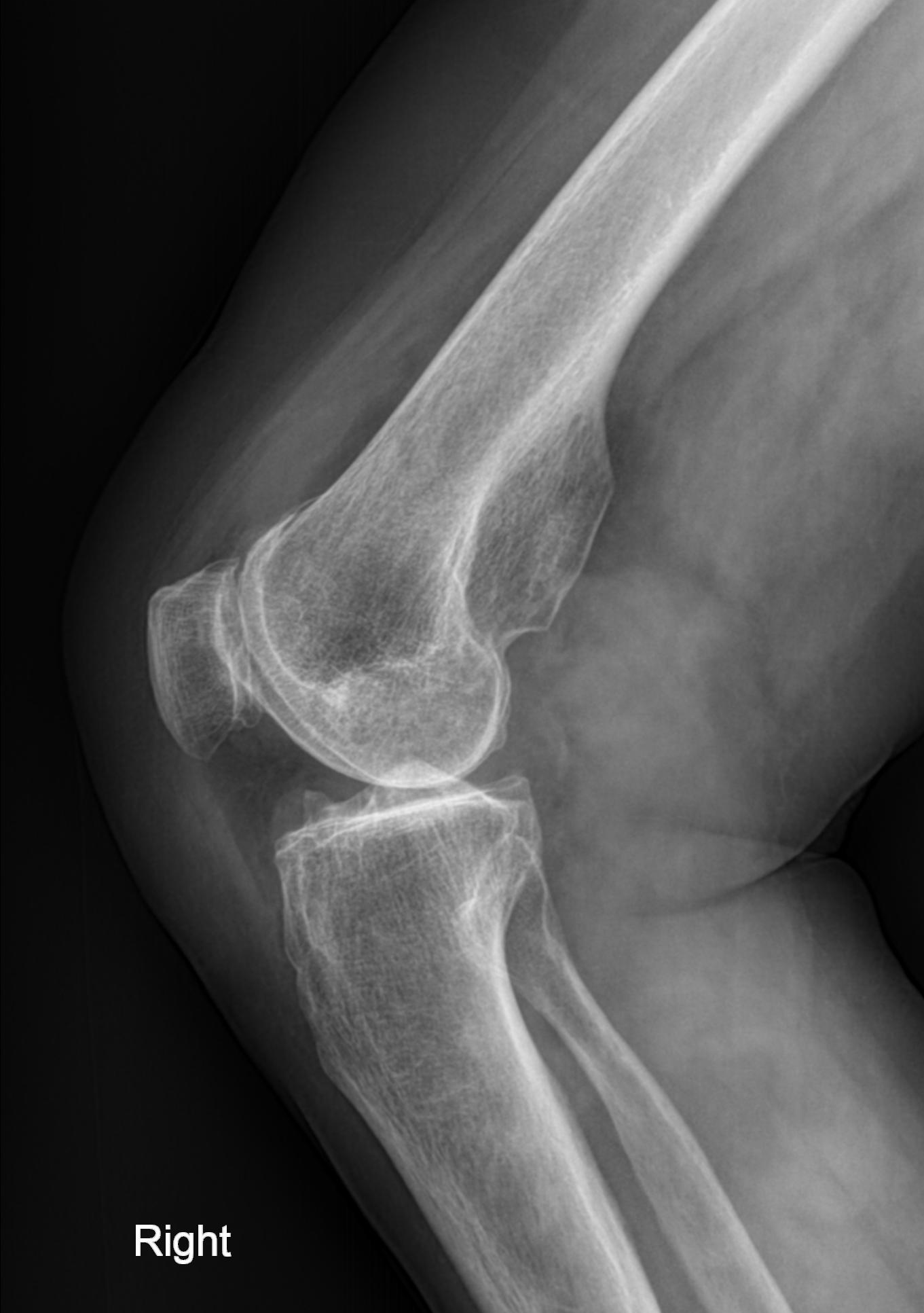 Sessile osteochondroma | Image | Radiopaedia.org