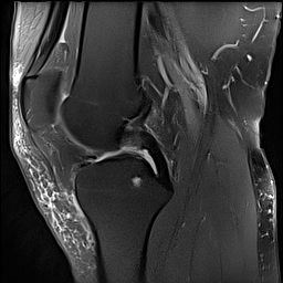 Intratendinous ganglion cyst of patellar tendon | Image | Radiopaedia.org