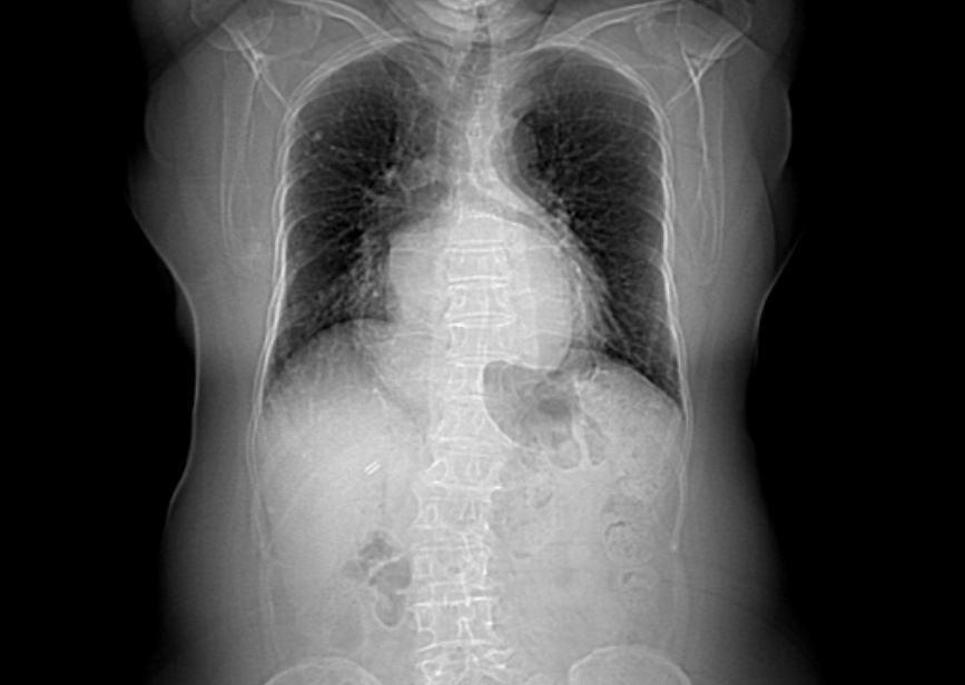 Medium Size Hiatal Hernia