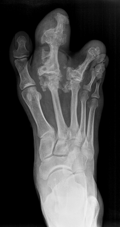 Macrodystrophia lipomatosa | Radiology Case | Radiopaedia.org