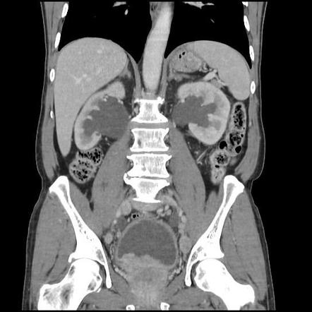 Transitional cell carcinoma - bladder | Radiology Case | Radiopaedia.org