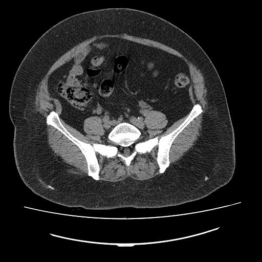 What Is Epiploic Appendagitis How Is It Treated