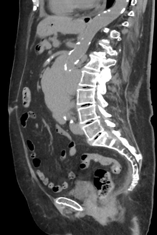 Diffuse Large B Cell Lymphoma With Bilateral Renal Involvement | Image ...