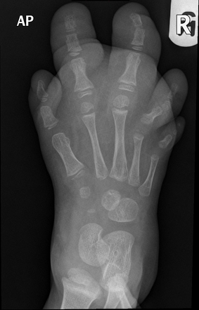 Macrodystrophia lipomatosa | Radiology Case | Radiopaedia.org