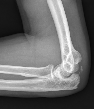 Elbow Fracture | Image | Radiopaedia.org