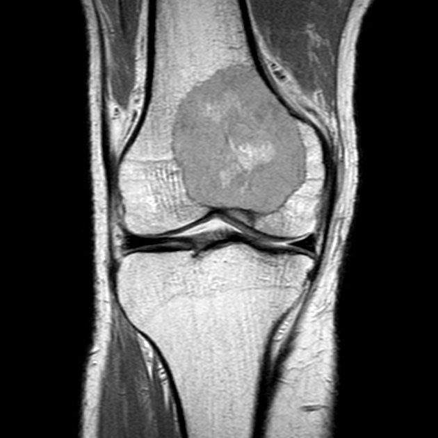 Giant cell tumor - knee | Radiology Case | Radiopaedia.org