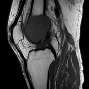 Giant cell tumor - knee | Radiology Case | Radiopaedia.org