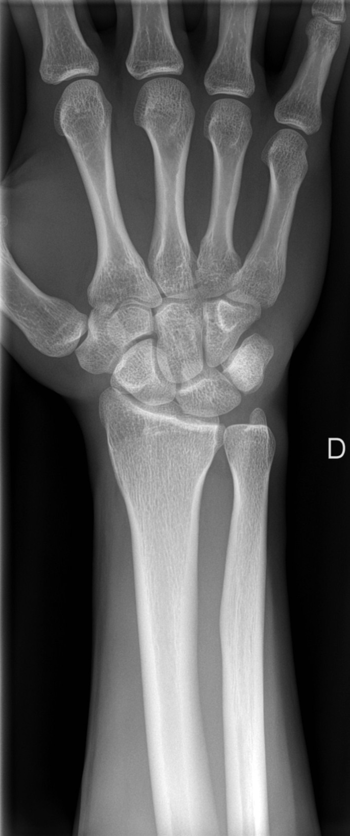 Pisiform fracture - flexor carpi ulnaris avulsion | Image | Radiopaedia.org