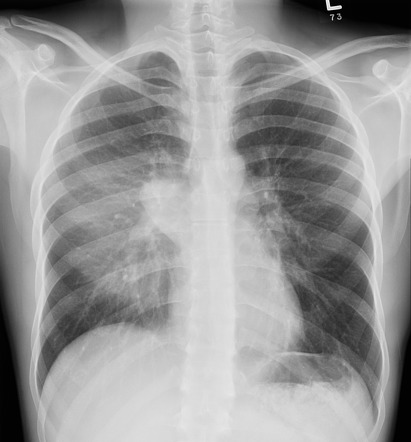 Mycobacterium phlei abscesses | Radiology Case | Radiopaedia.org