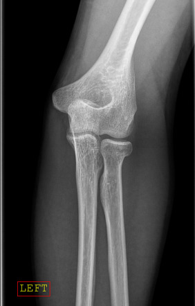 Elbow joint effusion - fat pad sign | Radiology Case | Radiopaedia.org