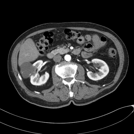 Hemorrhagic renal cyst masquerading as Bosniak 4 mass lesion (CEUS ...