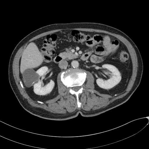 Hemorrhagic renal cyst masquerading as Bosniak 4 mass lesion (CEUS ...