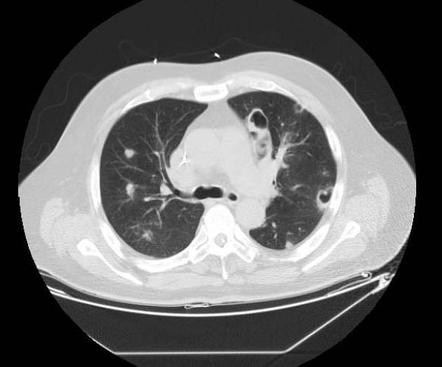 Septic pulmonary emboli | Radiology Reference Article | Radiopaedia.org