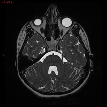 Trigeminal Neuralgia Mri