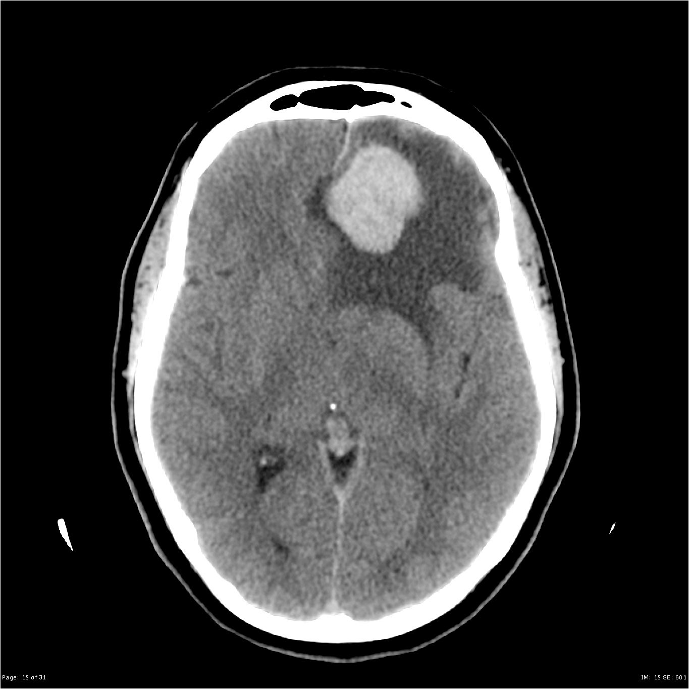 Solitary Fibrous Tumor Histology