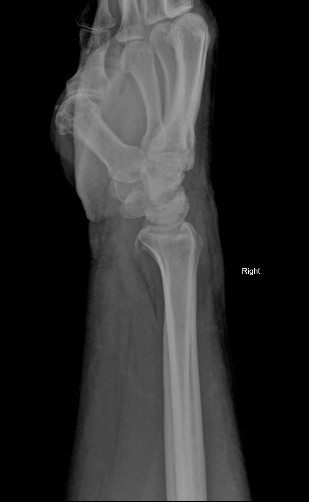 Chauffeur fracture | Image | Radiopaedia.org