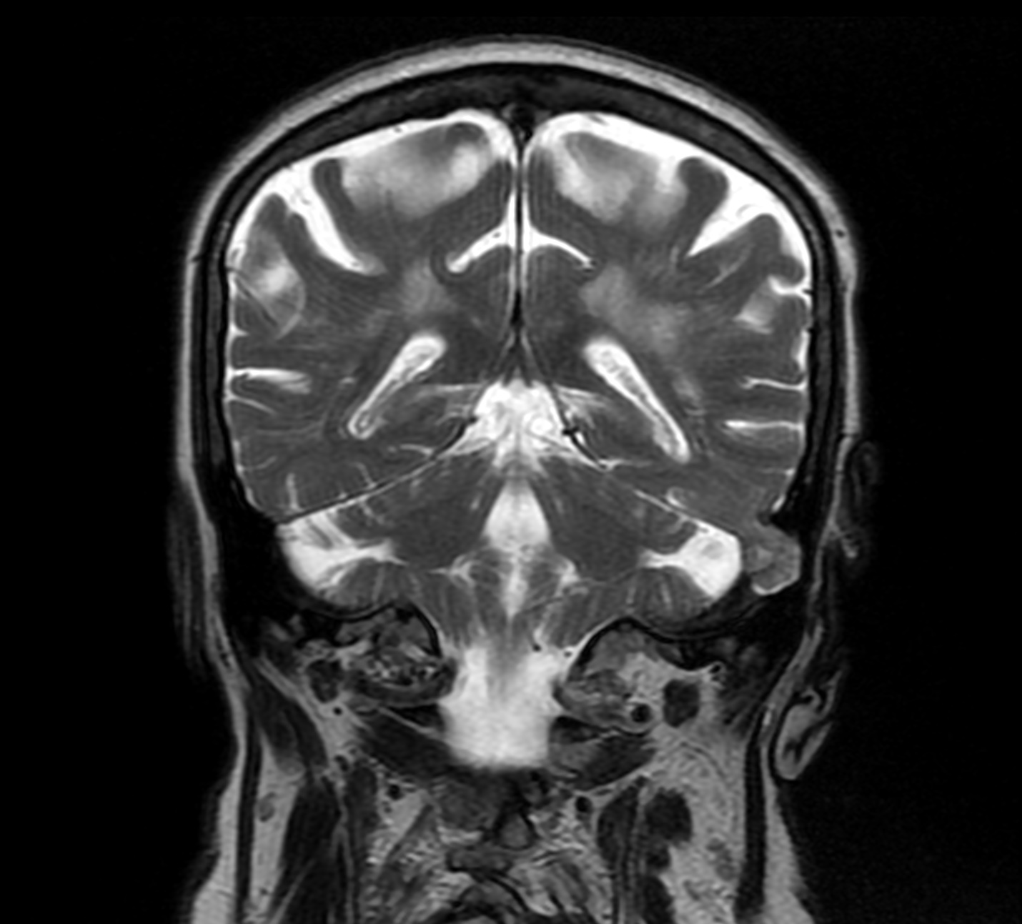 Encephalocele Into The Transverse Sinus Image